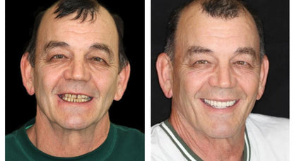 Smileasego™ - Premium Denture
