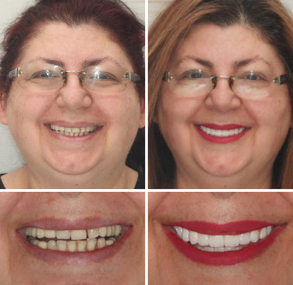 Smileasego™ - Premium Denture